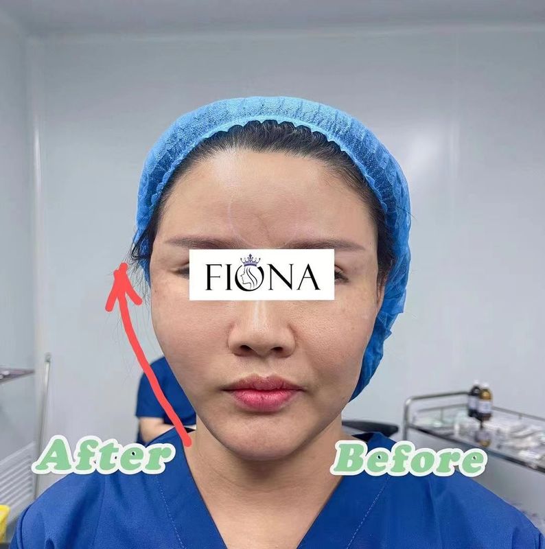 O gás absorvente do EO do elevador da linha da roda denteada de PDO esterilizou para os olhos do Fox do elevador da sobrancelha